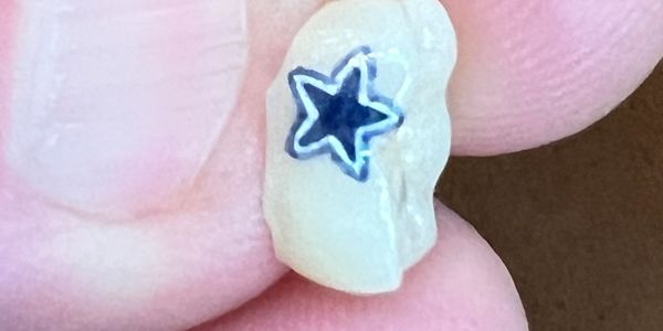 Dallas cowboys logo tattooed on tooth or crown.