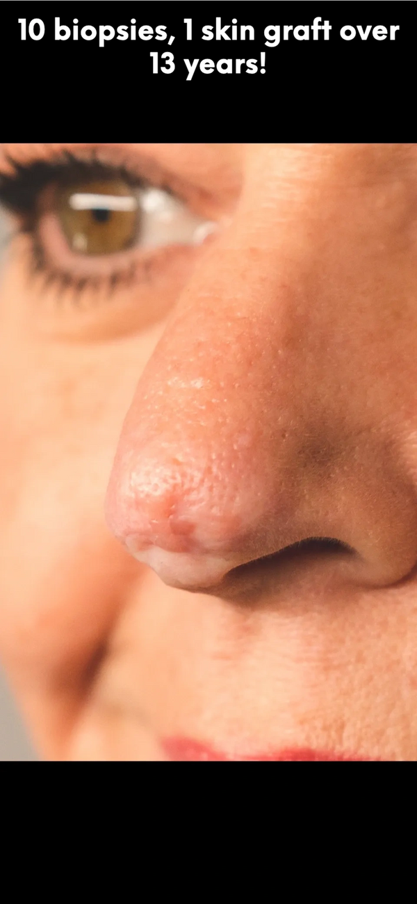 close up of lesion on nose tip