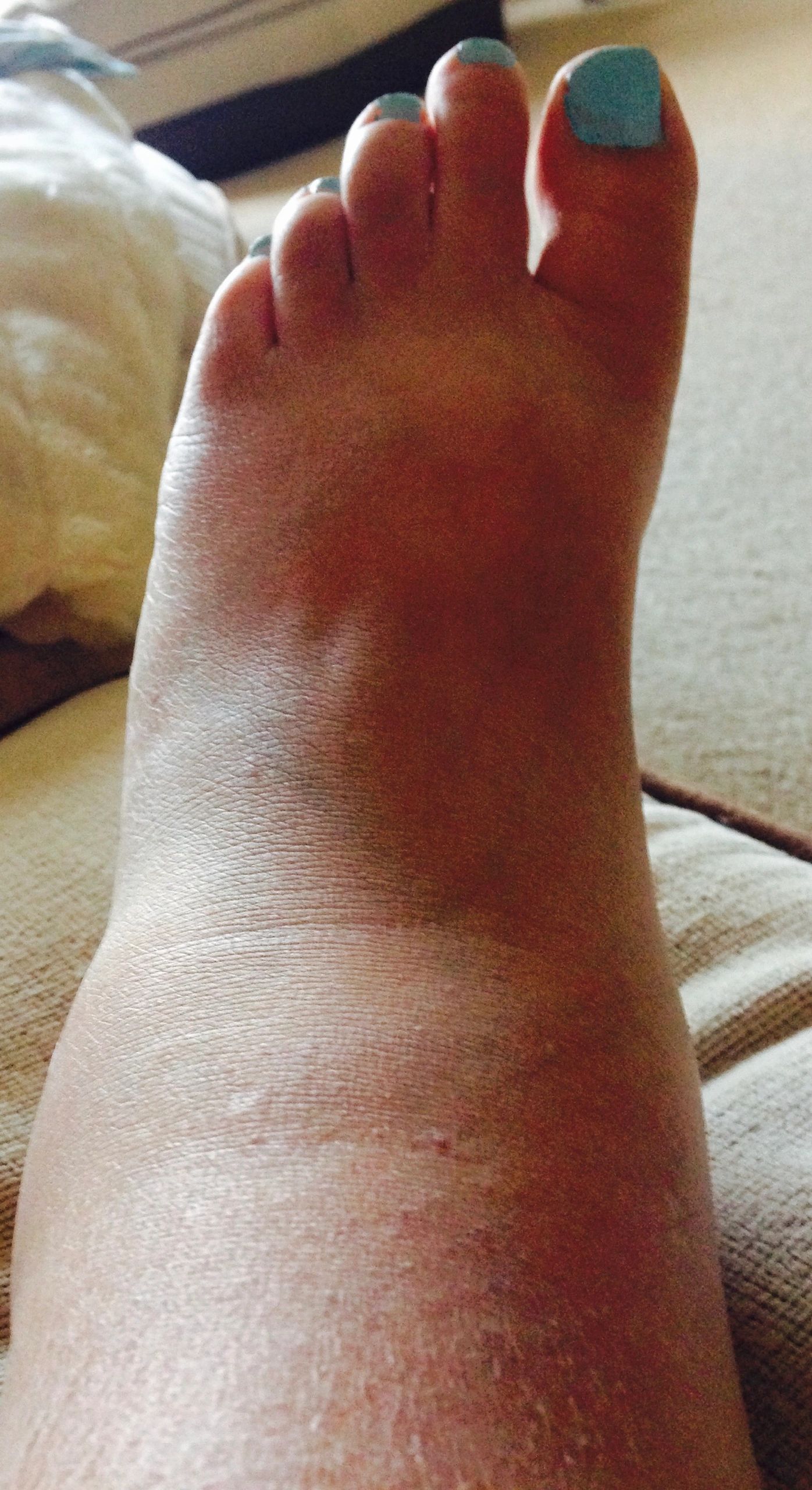 Suffering from Swollen Feet and Ankles in the hot weather?