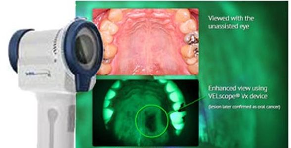 VELscope® Oral Cancer Screening