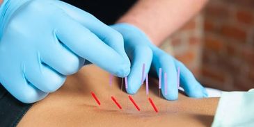 Target pain, and enhance mobility with functional dry-needling