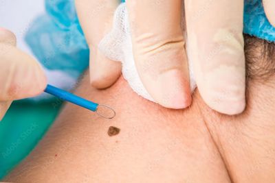 Mole removal with Surgitrone Ellman device