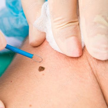 Mole removal by Surgitrone