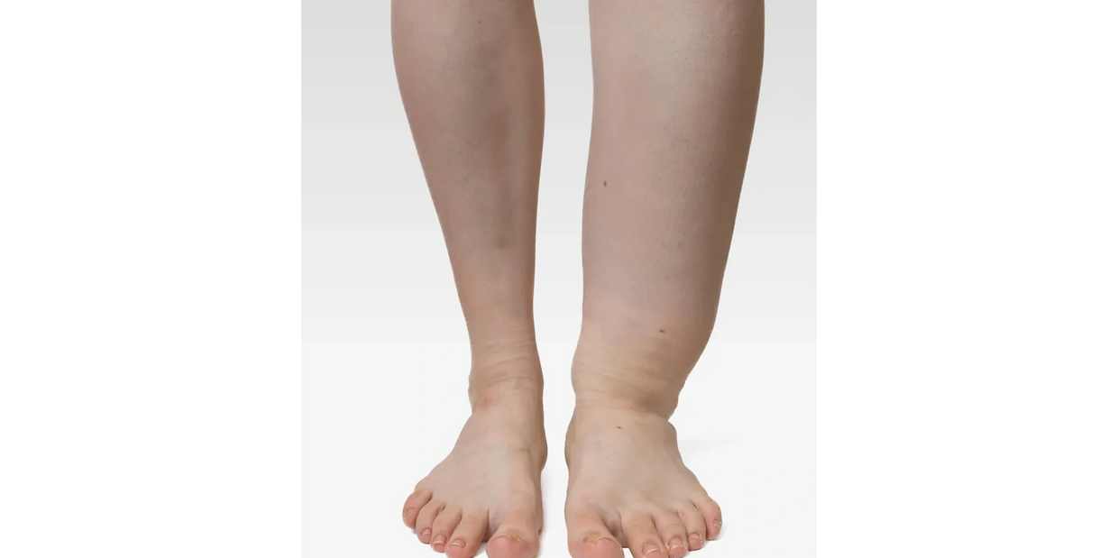Lymphoedema legs