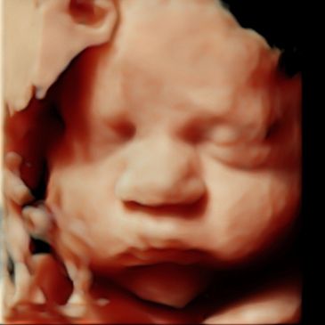 32 Week Ultrasound