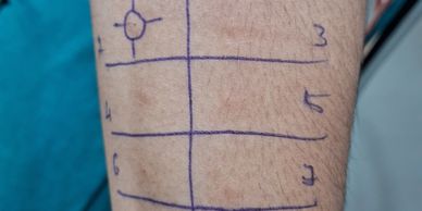 Skin allergy test markings on an arm.