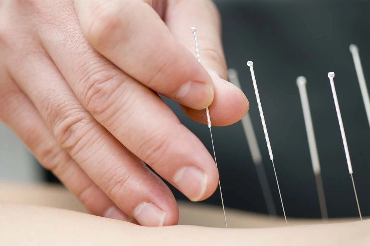 Electro-Acupuncture