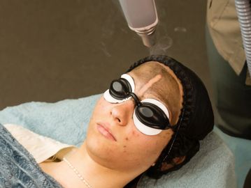 Carbon facial Collagen rejuvenation