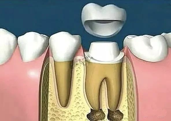 dental zirconia block， dental milling machine，detal cnc milling machine