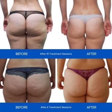 Cellulite treatment, anti-cellulite, skin tightening, EndoLuxx, zemits, body contouring, Endospheres