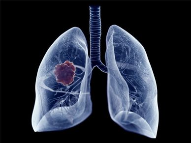 lung cancer