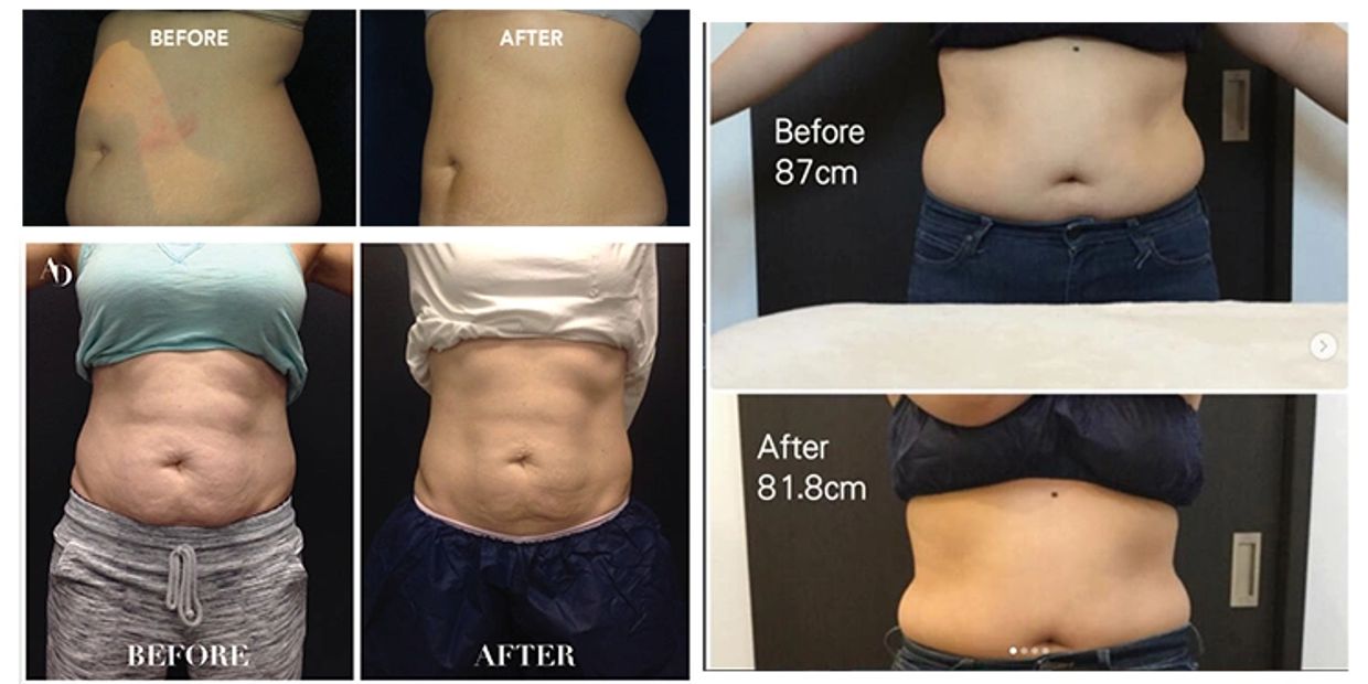 PROMO MONTH Abdomen Cavitation 50% OFF FREE Abdomen Pressotherapy