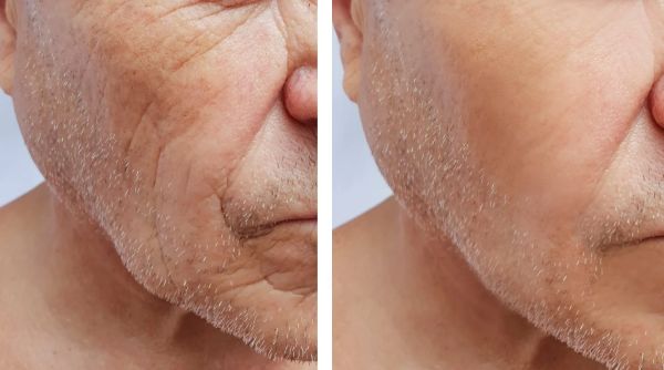 Side-by-side comparison of aged and rejuvenated skin on a man's face.