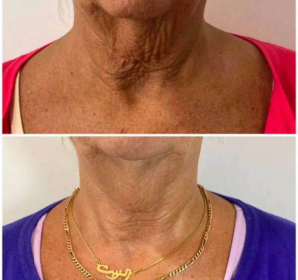 Before and after images showing neck skin improvement.