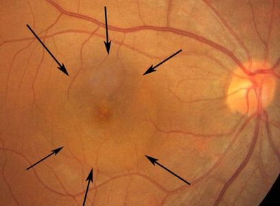 中心性漿液性脈絡膜視網膜病變, 黃斑積水, 中醫眼科