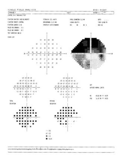 青光眼視野檢查結果