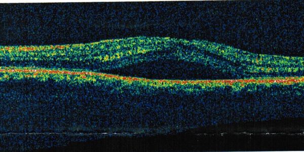 黃斑積水, 中醫眼科,中心性漿液性脈絡膜視網膜病變