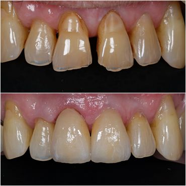 Before and after dental restoration of front teeth.
