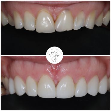Before and after images showing improved dental alignment and whitening.