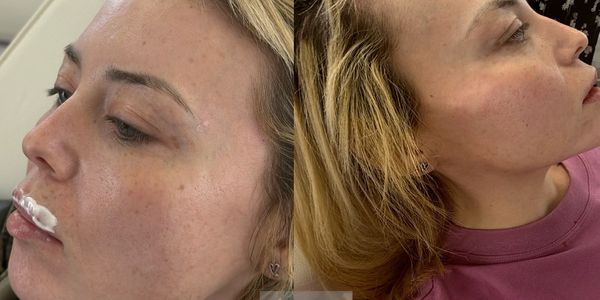 Jaw filler and cheek