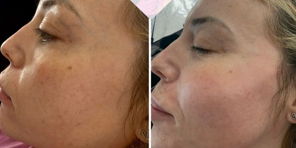 aesthetic treatments Woking dermal fillers