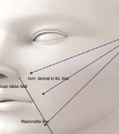Thread lifts help to reposition cheek skin higher and more youthfully