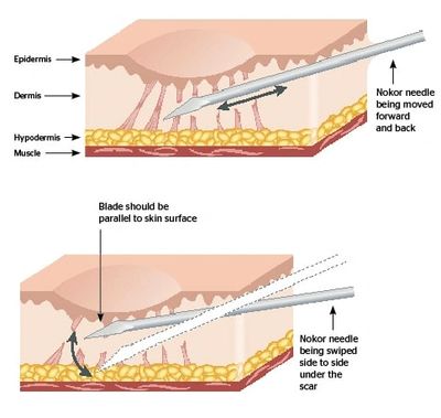 Subcision readily reduces the indents of cellulite, simply and comfortably