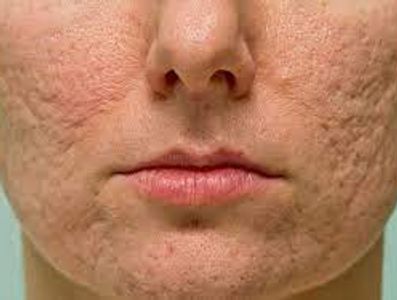 Extensive mature atrophic acne scars we improve with the latest treatments