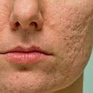 We treat acne scars