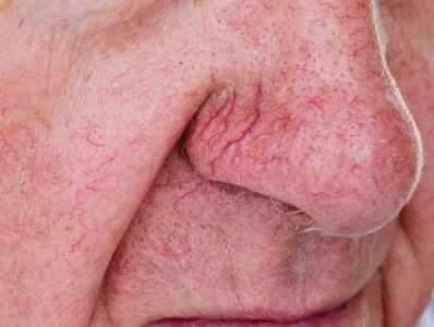 Broken capillaries on the nose suitable for our vascular laser treatment