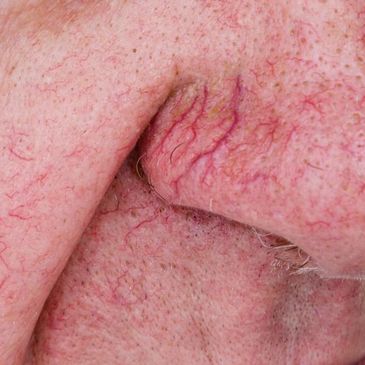we treat broken capillaries and spider veins