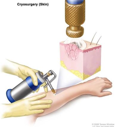 Liquid nitrogen for solar keratoses, seborrhoeic keratoses, warts, etc