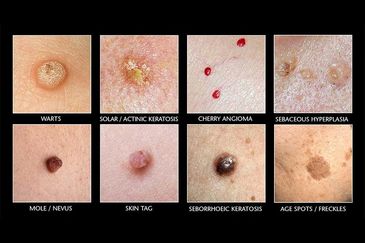 Removing unsightly dots spots and bumps we do expertly and expediently. Just fix them.