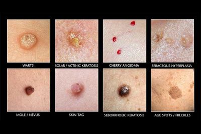 Bothersome dots spots and bumps are easily removed or vastly improved. Just ask