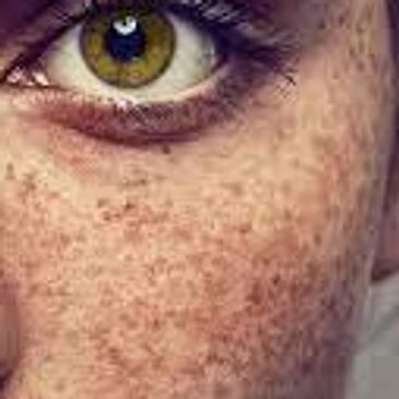 We treat freckles and pigmentation