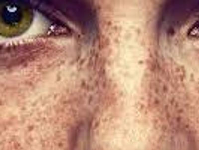 Freckles and other pigmentation conditions are readily improved with IPL
