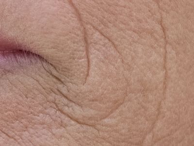 Facial lines we've treated medically by injection for over 25 years