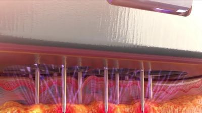 RadioFrequency Microneedling deposits growth-stimulating energy exactly where needed