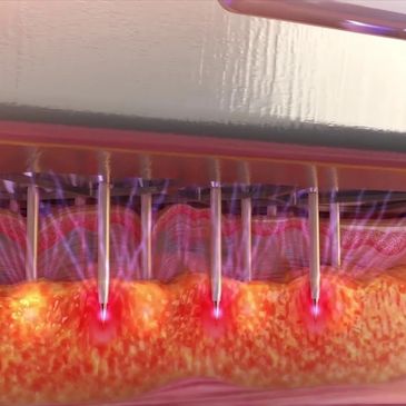 Radiofrequency Microneedling stimulates new collagen at the exact right depth
