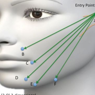 Facial Thread Lifts restore a more youthful and lifted facial shape