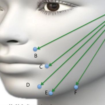 Thread lifts work to reposition jowls back for a smoother younger facial shape