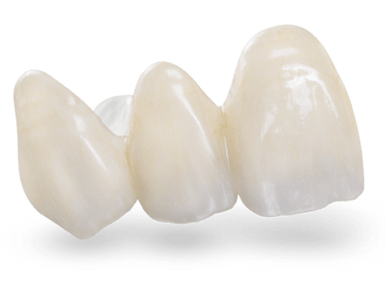 Emax e-max porselen diş kaplama köprü 