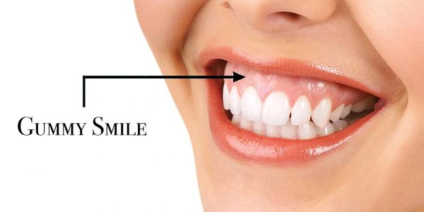 Diş eti gülümsemesi, gummy smile, botoks
