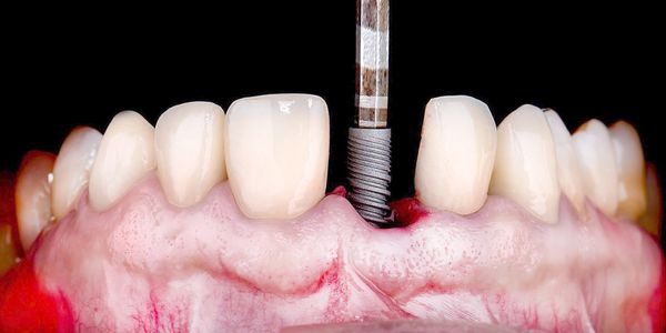 Cerrah, implant uzmanı, diş implantı, diş hekimi