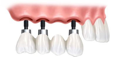 Diş implantı 