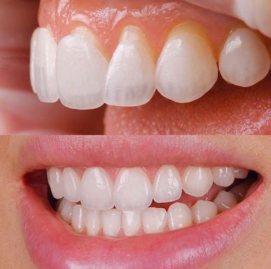 Lamina diş porselen estetik 