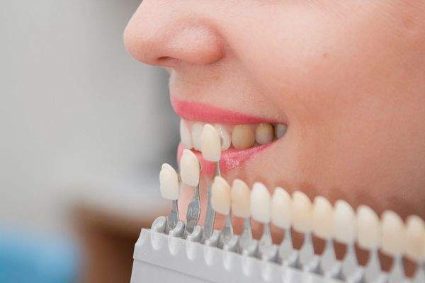 This patient is choosing the correct shade by color-matching to her own teeth for cosmetic veneers.