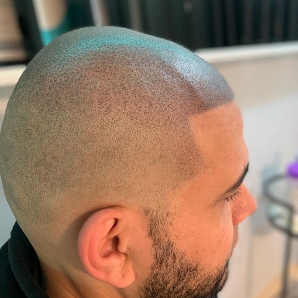 Scalp Micro-pigmentation.is a non-surgical procedure, low maintenance solution to hair loss.