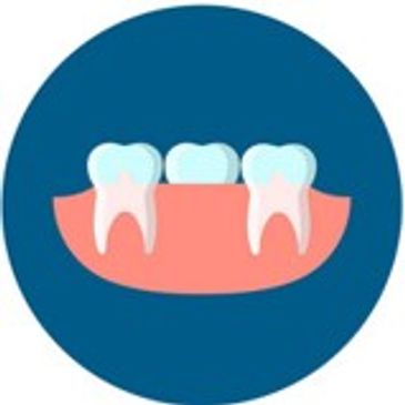 a cartoon depiction of a dental bridge