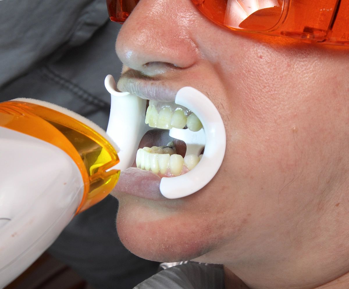 Person undergoing teeth whitening with mouth retractor and protective glasses.